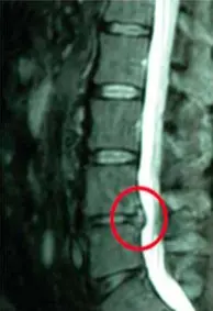 MRI of the same lower spine, after: the circled bulge is much smaller and no longer presses into the canal