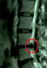 MRI of a lower spine, before: a circled disc herniation pressing into the spinal canal
